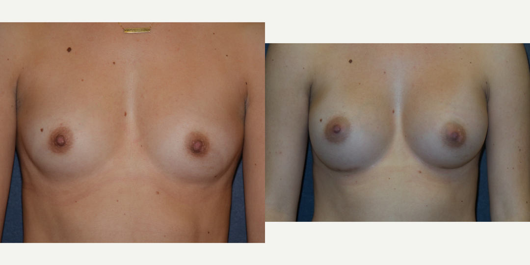Breast Augmentation procedure image