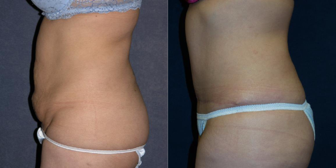 Tummy Tuck (Abdominoplasty) procedure image