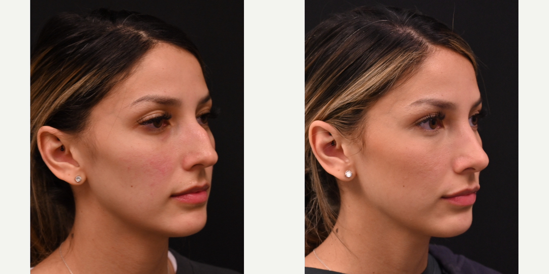 Rhinoplasty (Nose Job) procedure image