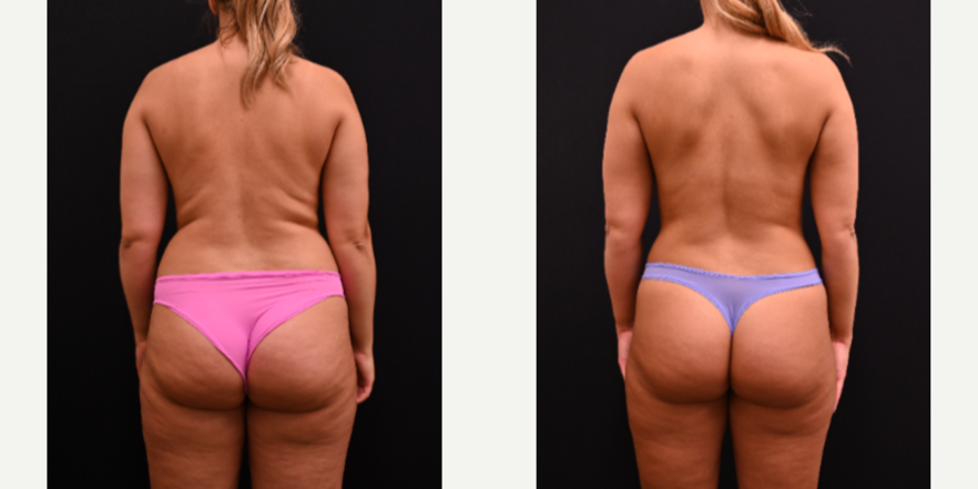 Liposuction procedure image