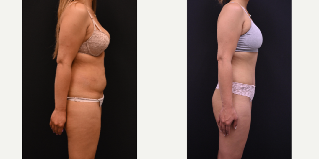 Mommy Makeover procedure image