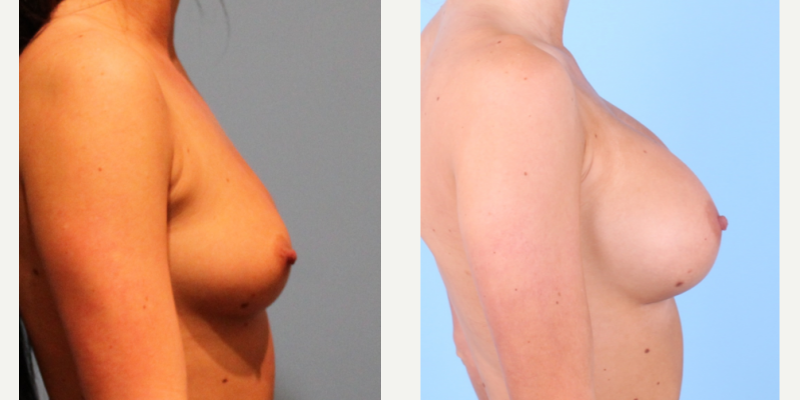 Breast Augmentation procedure image