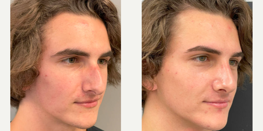 Rhinoplasty (Nose Job) procedure image