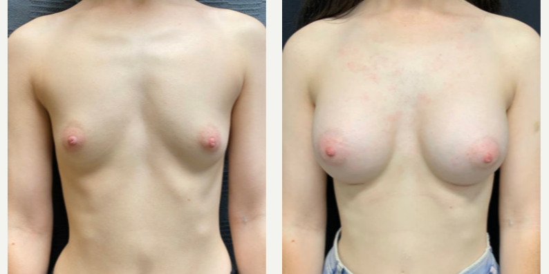 Breast Augmentation procedure image