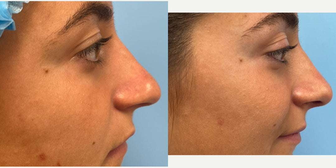 Rhinoplasty (Nose Job) procedure image