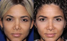 Rhinoplasty (Nose Job) procedure image