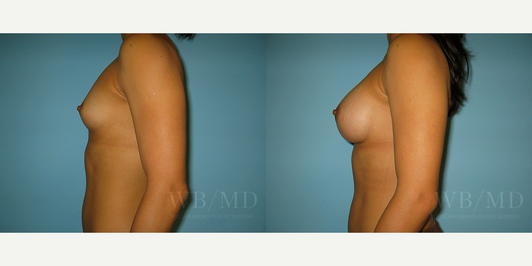 Brazilian Butt Lift (BBL) procedure image