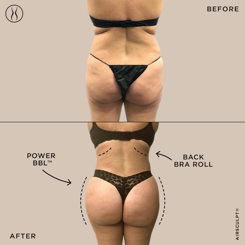 Brazilian Butt Lift (BBL) procedure image