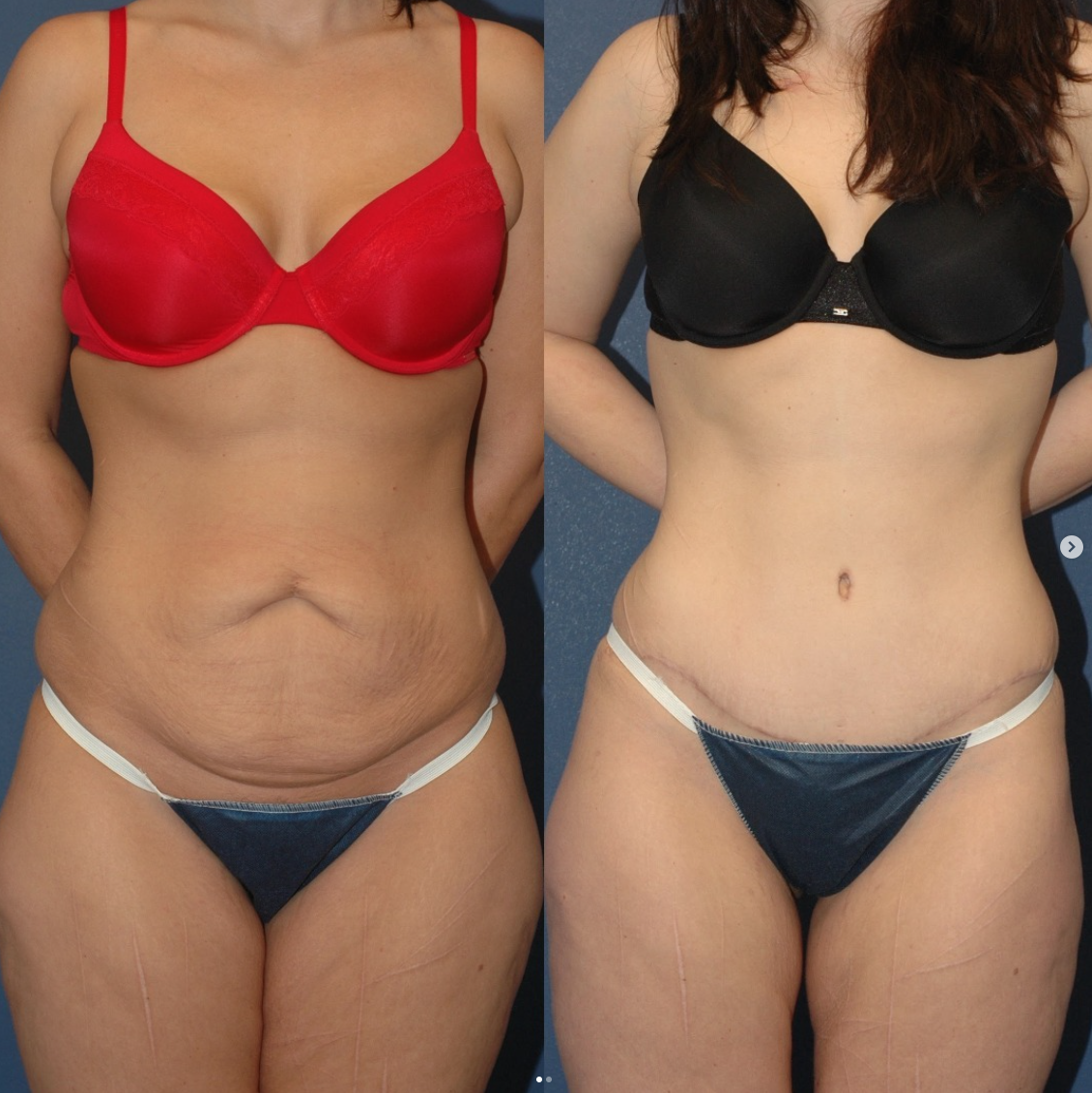 Mommy Makeover procedure image