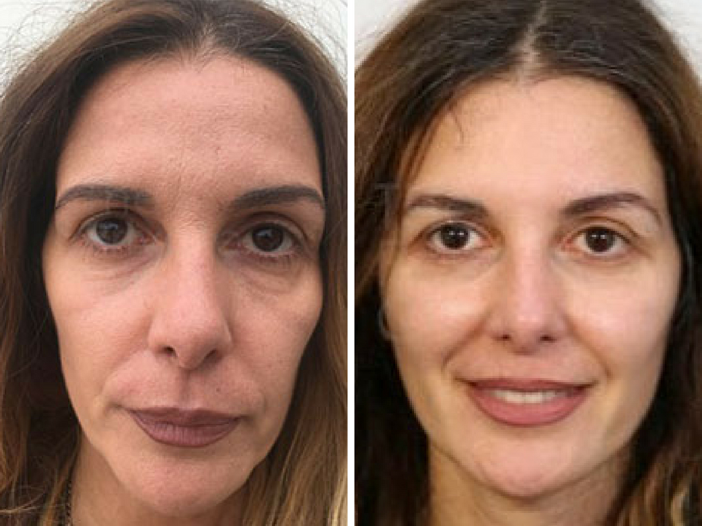 Facelift procedure image