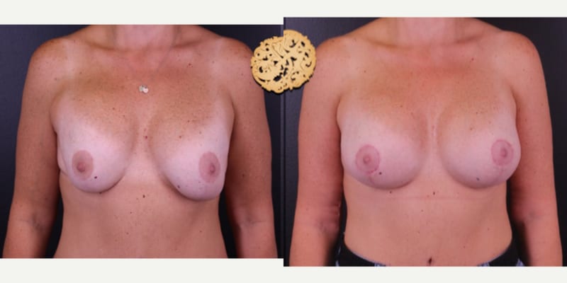 Mommy Makeover procedure image