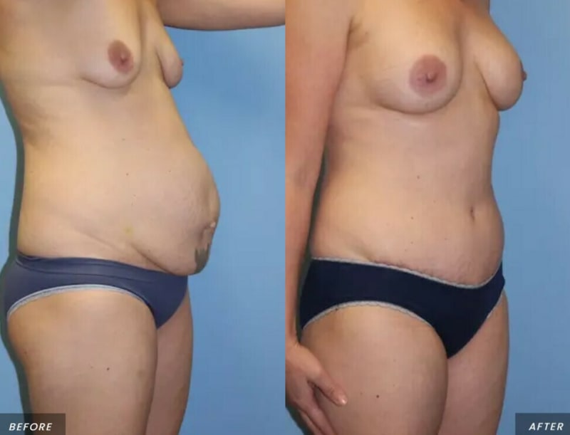 Skin Tightening procedure image