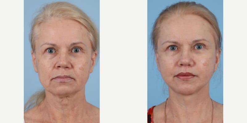 Facelift procedure image