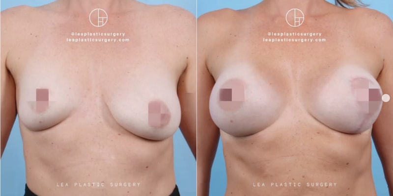 Breast Augmentation procedure image