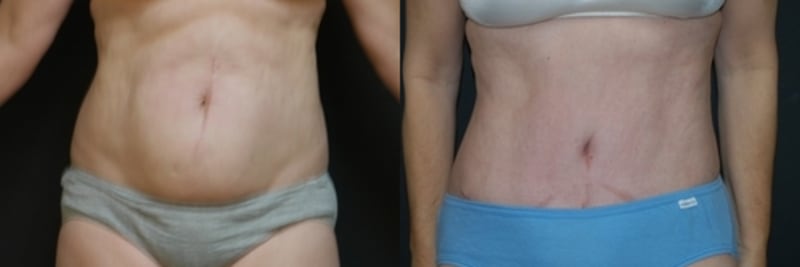 Skin Tightening procedure image