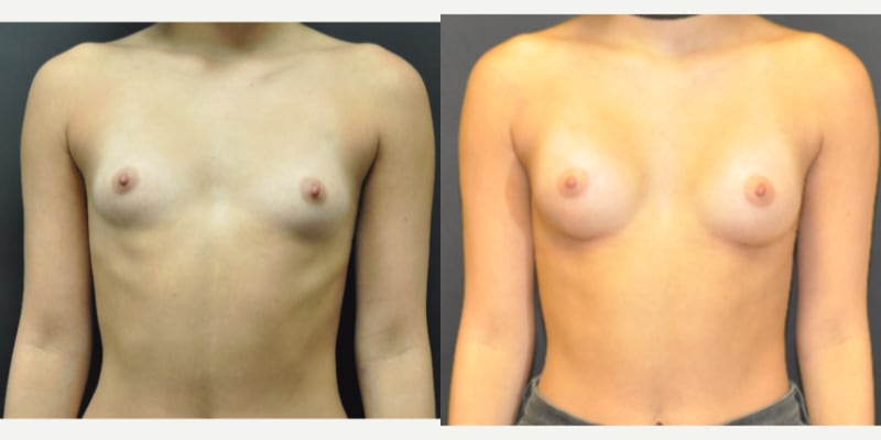 Mommy Makeover procedure image