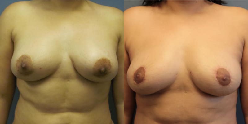 Mommy Makeover procedure image