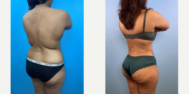 Mommy Makeover procedure image