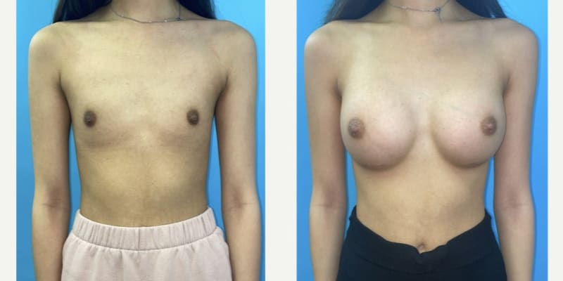 Breast Augmentation procedure image