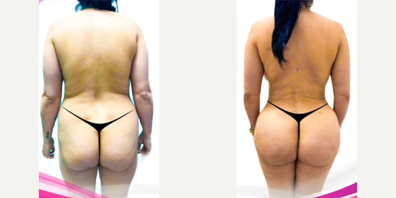 Hip Enhancement procedure image