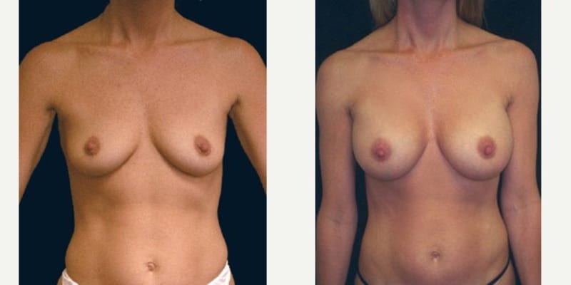Breast Augmentation procedure image