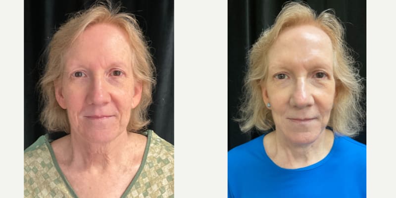 Facelift procedure image