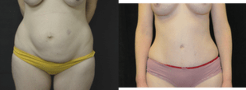 Mommy Makeover procedure image