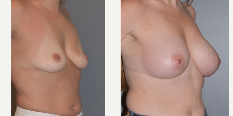 Breast Augmentation procedure image
