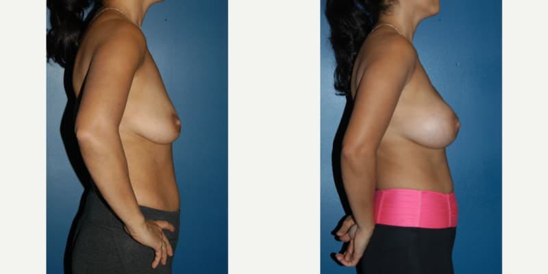 Mommy Makeover procedure image