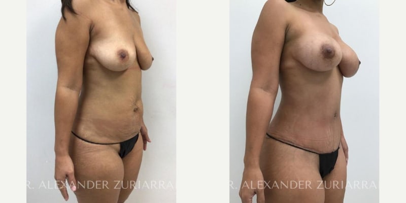 Breast Augmentation procedure image