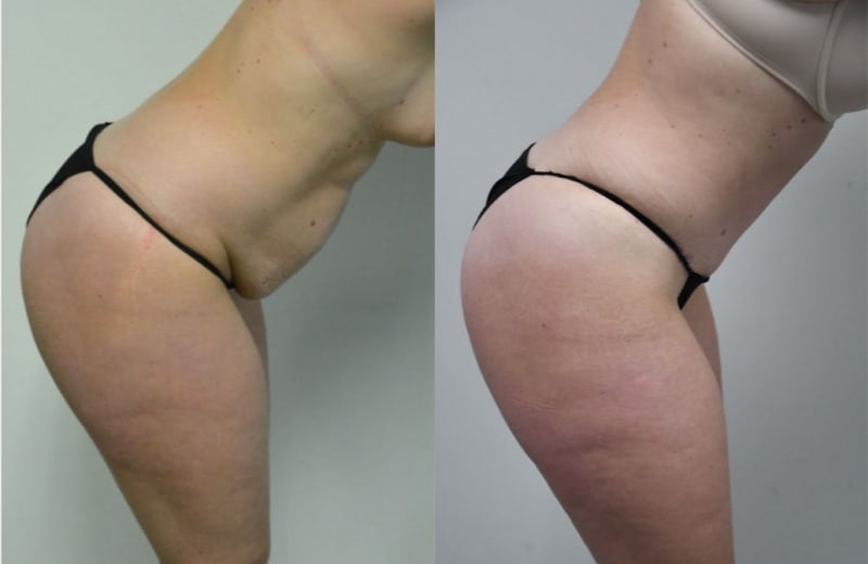 Tummy Tuck (Abdominoplasty) procedure image