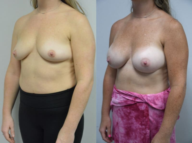 Breast Augmentation procedure image