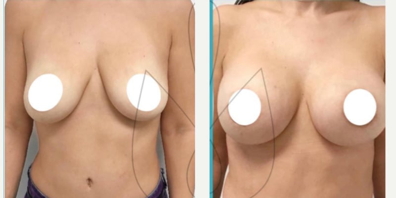 Breast Augmentation procedure image
