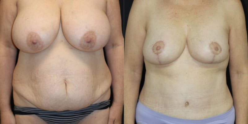 Breast Augmentation procedure image