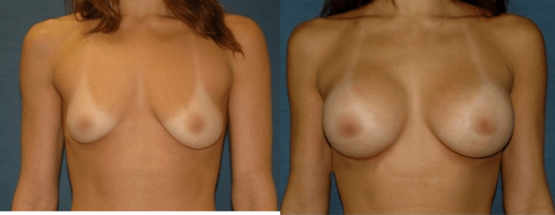 Breast Augmentation procedure image
