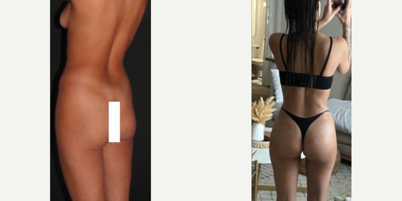 Body Lift procedure image