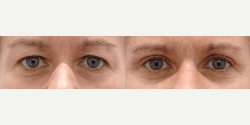 Eyelid Surgery (Blepharoplasty) procedure image
