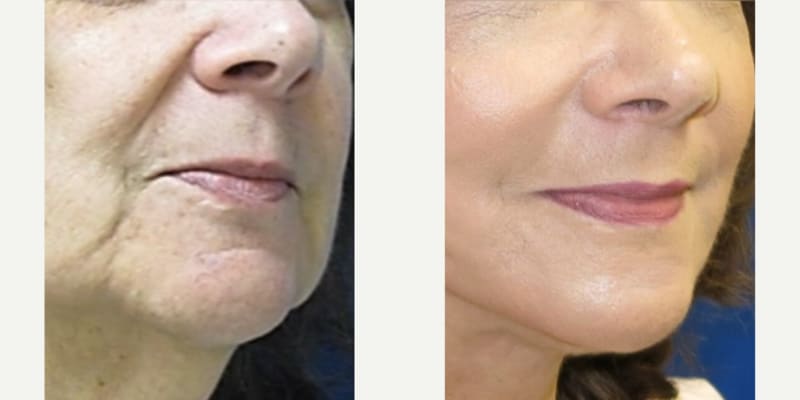 Cheek Enhancement procedure image