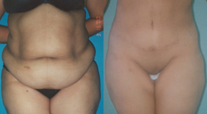 Mommy Makeover procedure image