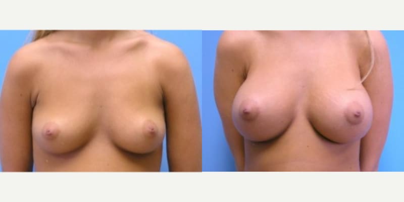 Breast Augmentation procedure image