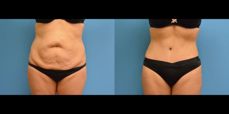 Tummy Tuck (Abdominoplasty) procedure image