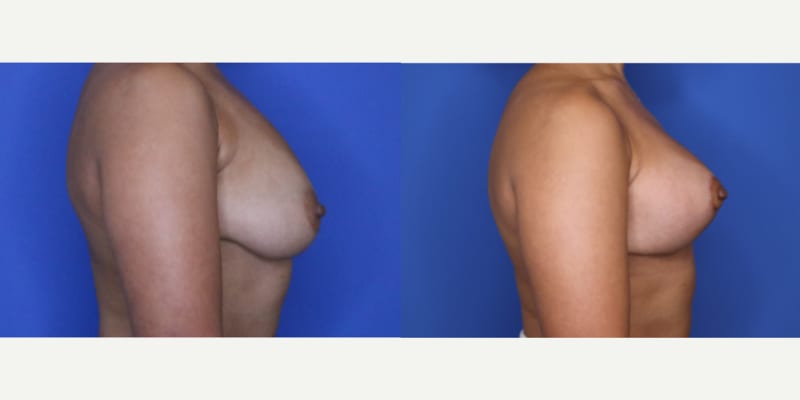 Mommy Makeover procedure image