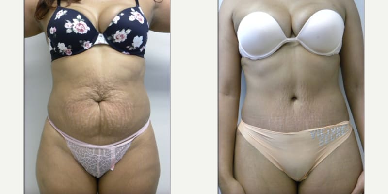 Mommy Makeover procedure image