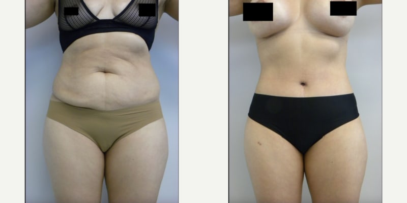Tummy Tuck (Abdominoplasty) procedure image
