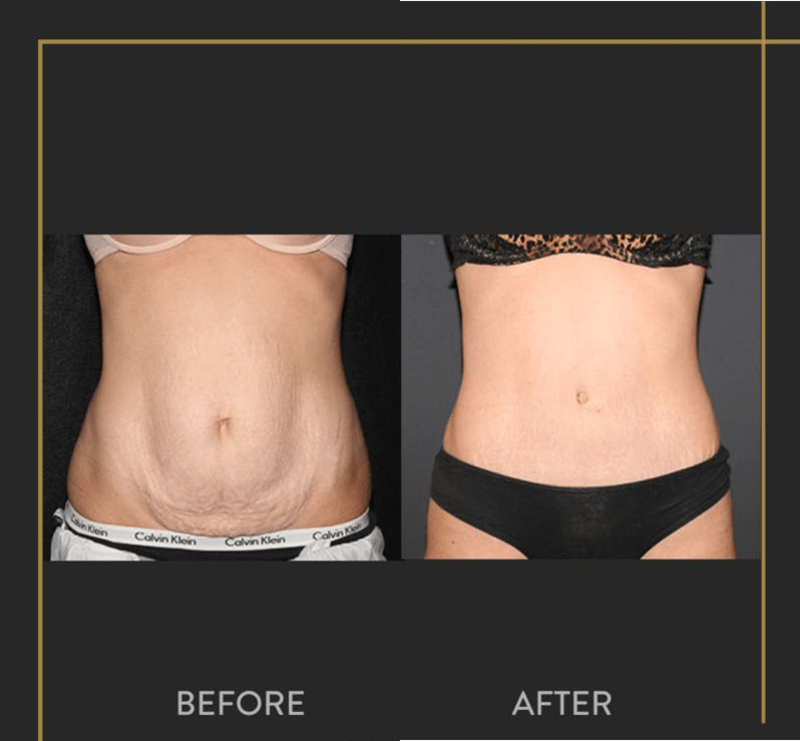 Mommy Makeover procedure image