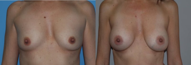 Breast Augmentation procedure image