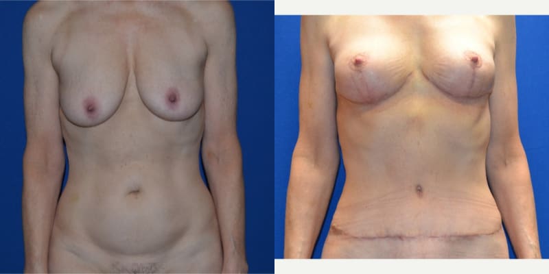 Skin Tightening procedure image