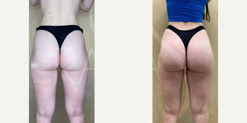 Hip Enhancement procedure image