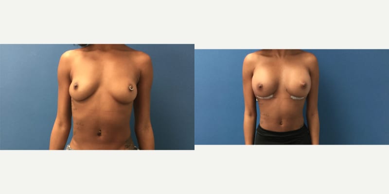 Breast Augmentation procedure image