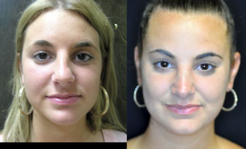 Facelift procedure image